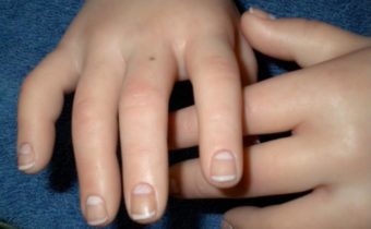 Что означают родинки на ладонях и пальцах